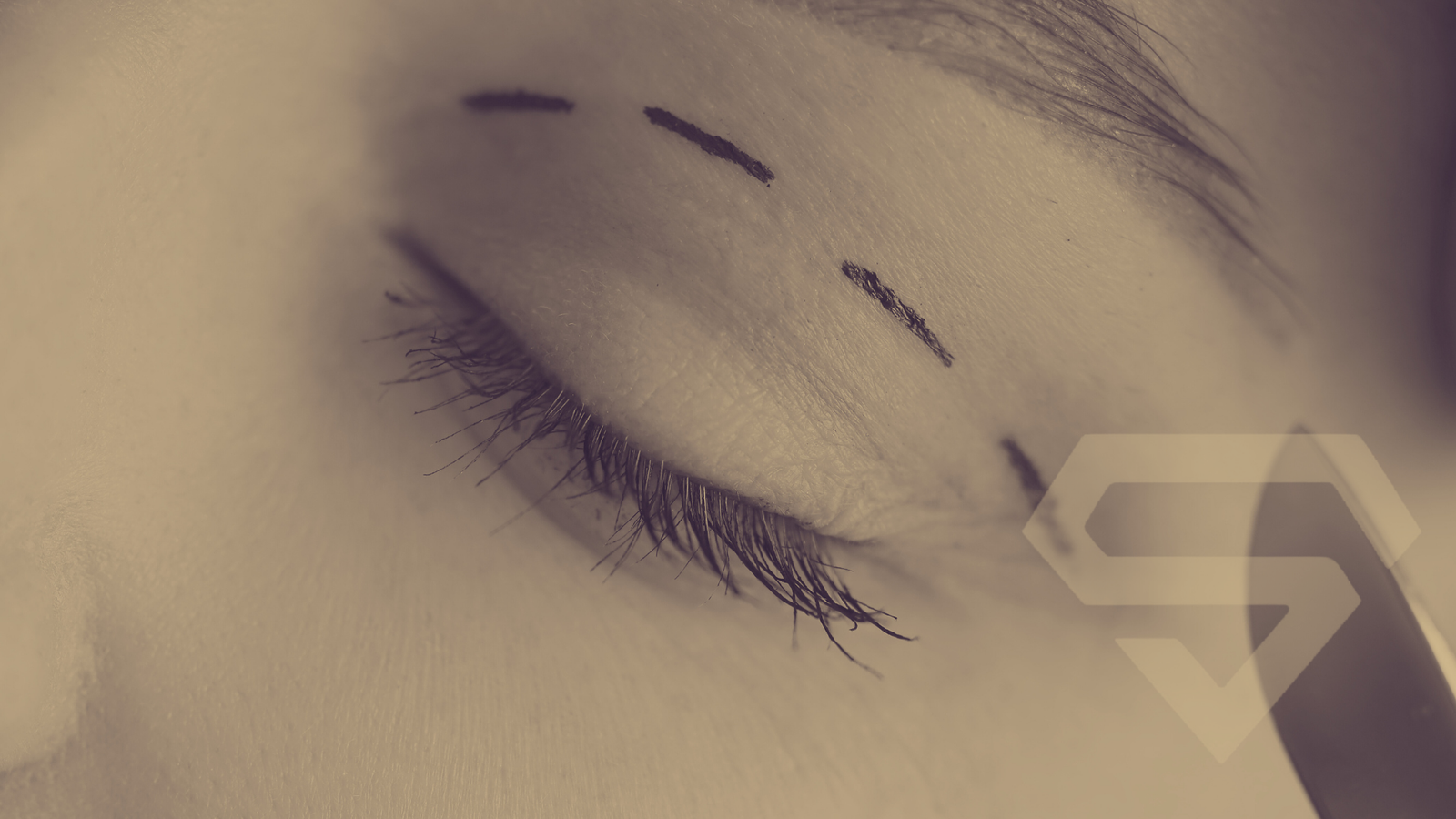 Konya Göz Kapağı Estetiği